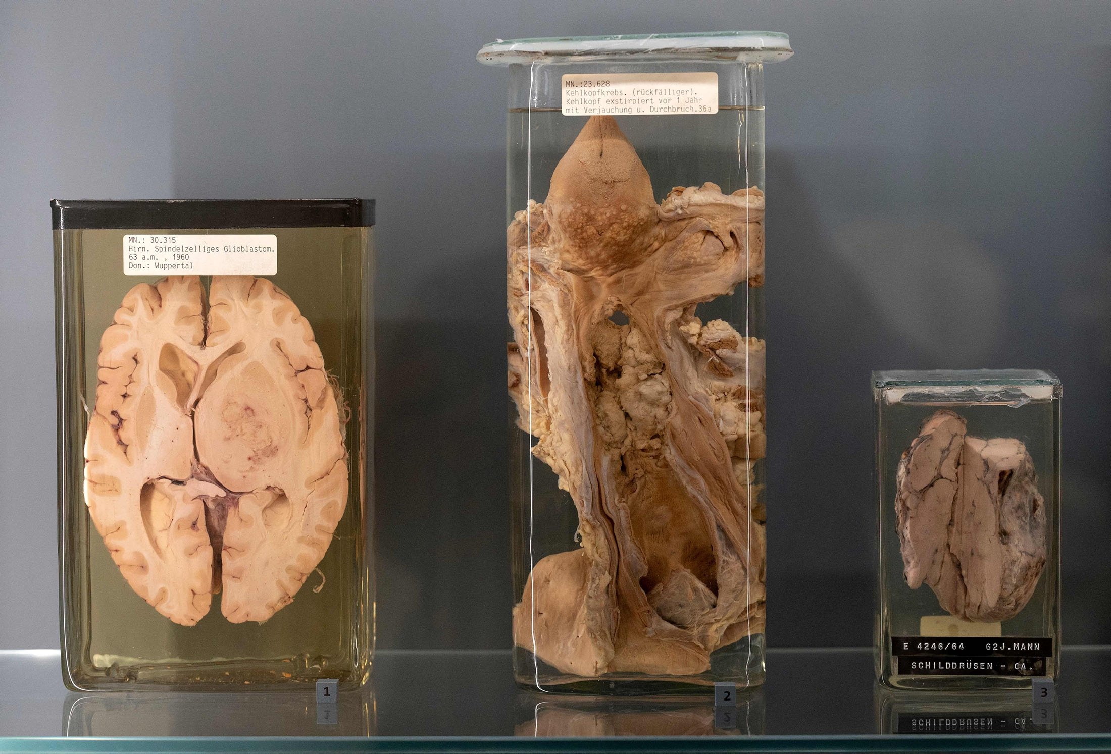 Exhibits of the anatomical pathology collection are displayed at Vienna's prestigious 'Narrenturm' Museum of Pathology in Vienna, Austria, on Oct. 20, 2021. (Photo by JOE KLAMAR / AFP)