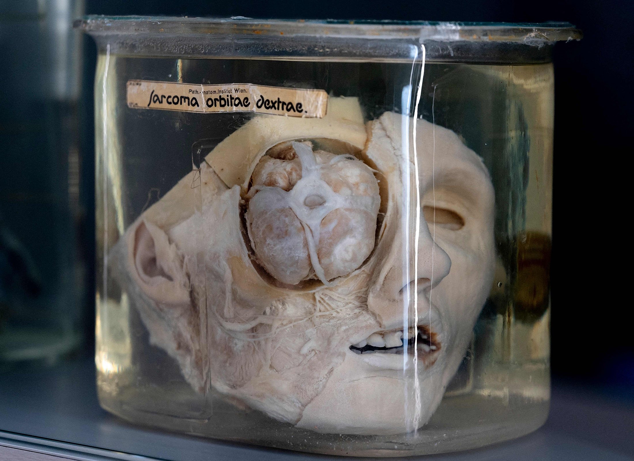 An exhibit of the anatomical pathology collection is displayed at Vienna's prestigious 'Narrenturm' Museum of Pathology in Vienna, Austria, on Oct. 20, 2021. (Photo by JOE KLAMAR / AFP)