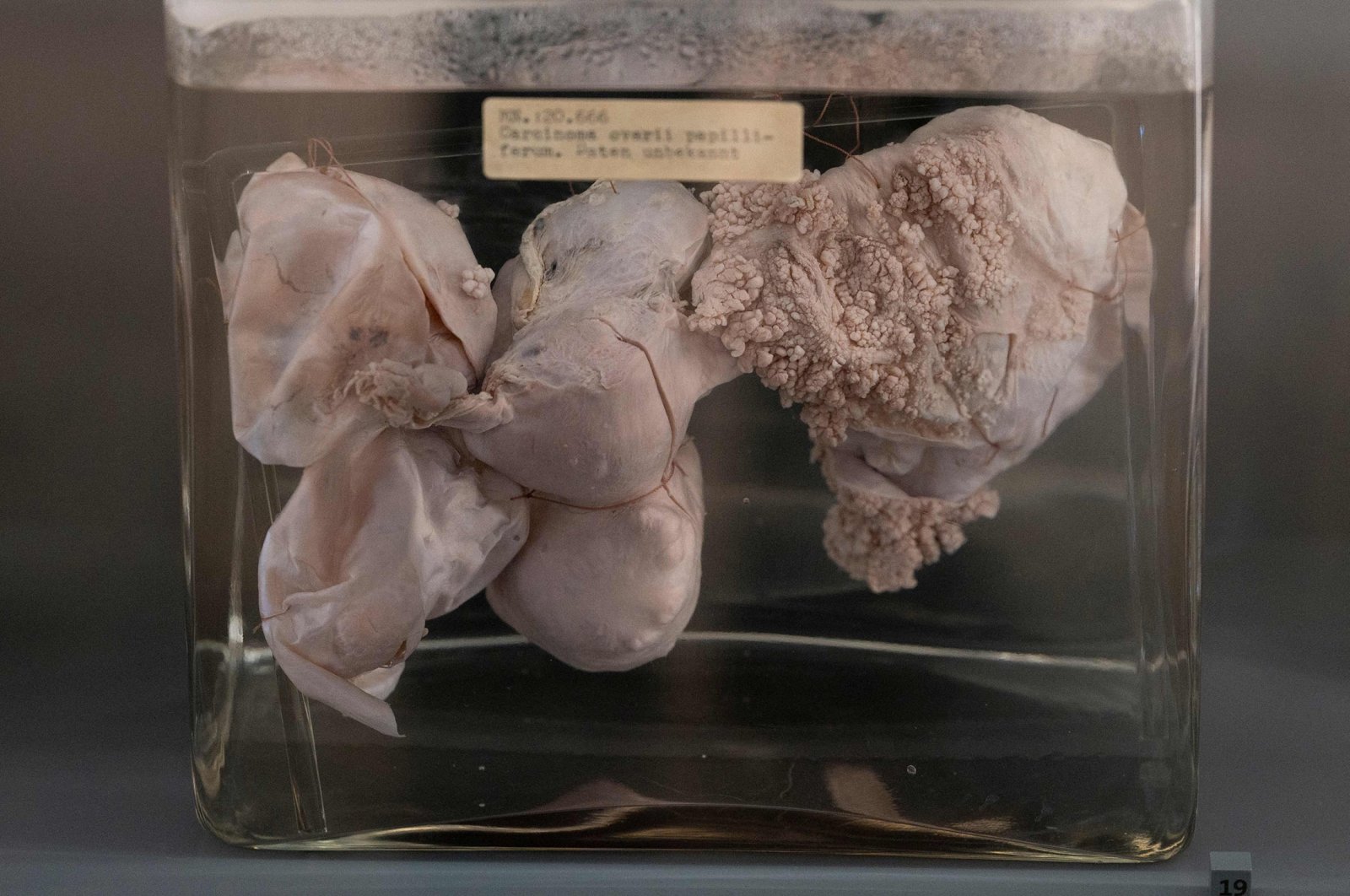An exhibit of the anatomical pathology collection is displayed at Vienna&#039;s prestigious &#039;Narrenturm&#039; Museum of Pathology in Vienna, Austria, on Oct. 20, 2021. (Photo by JOE KLAMAR / AFP)