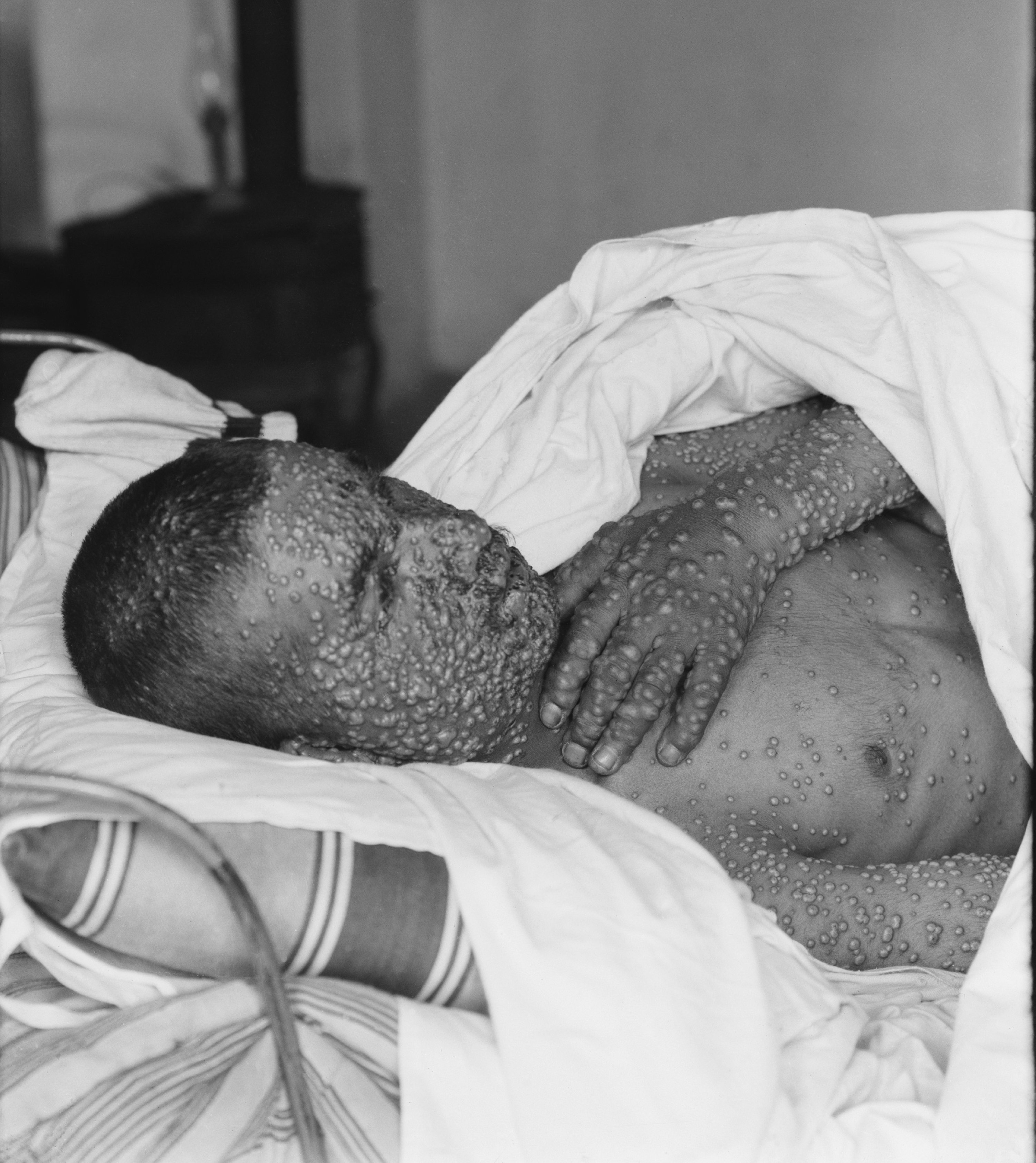 The heavily pockmarked face, arms and hands of a smallpox victim in Palestine, ca. 1900-1925. By 1980 the disease was finally eradicated by the World Health Organization.