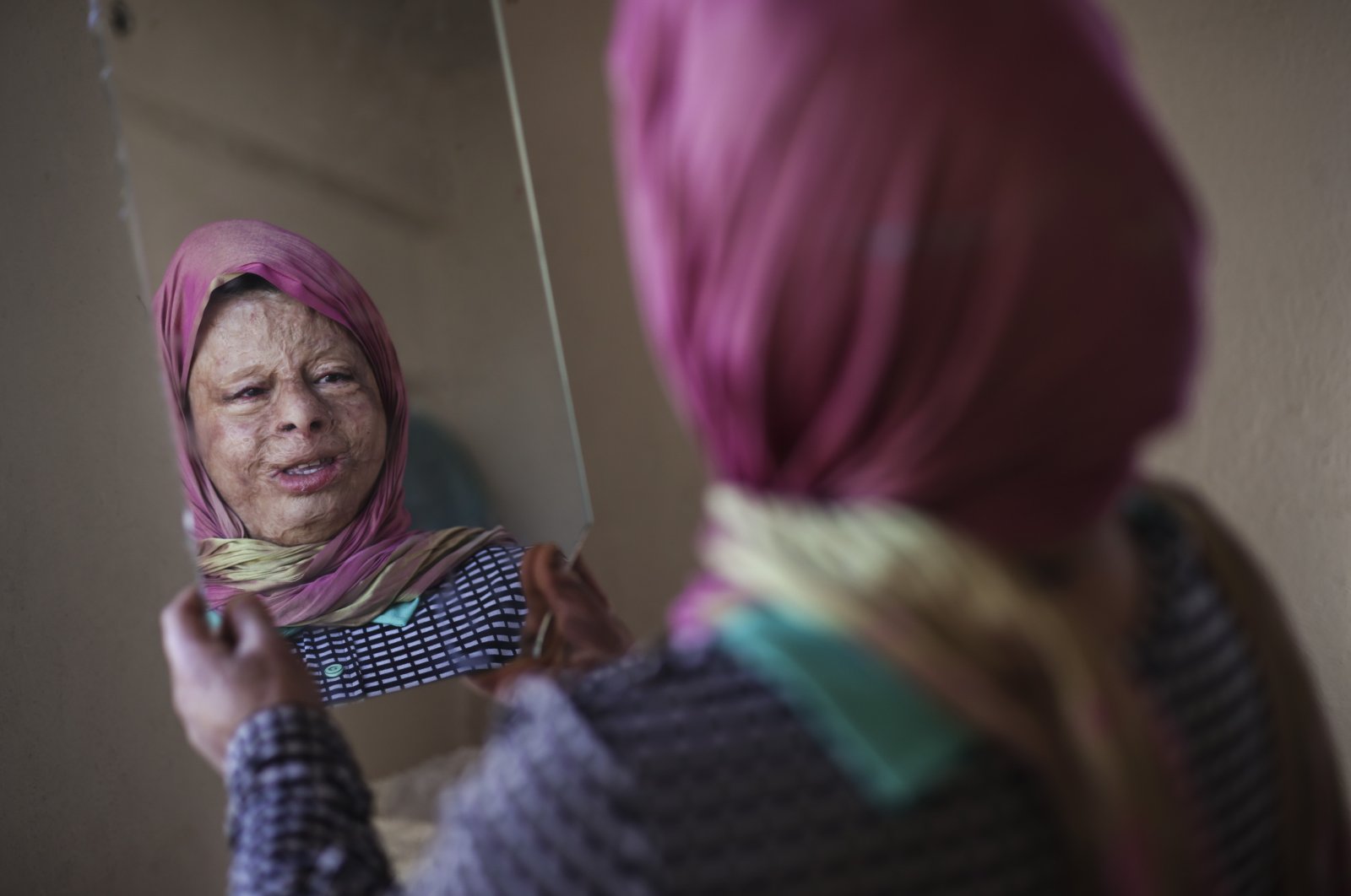 Amina Ismael looks at her reflection in a mirror in her home, Ankara, Turkey, Jan. 16, 2022. (AA PHOTO)
