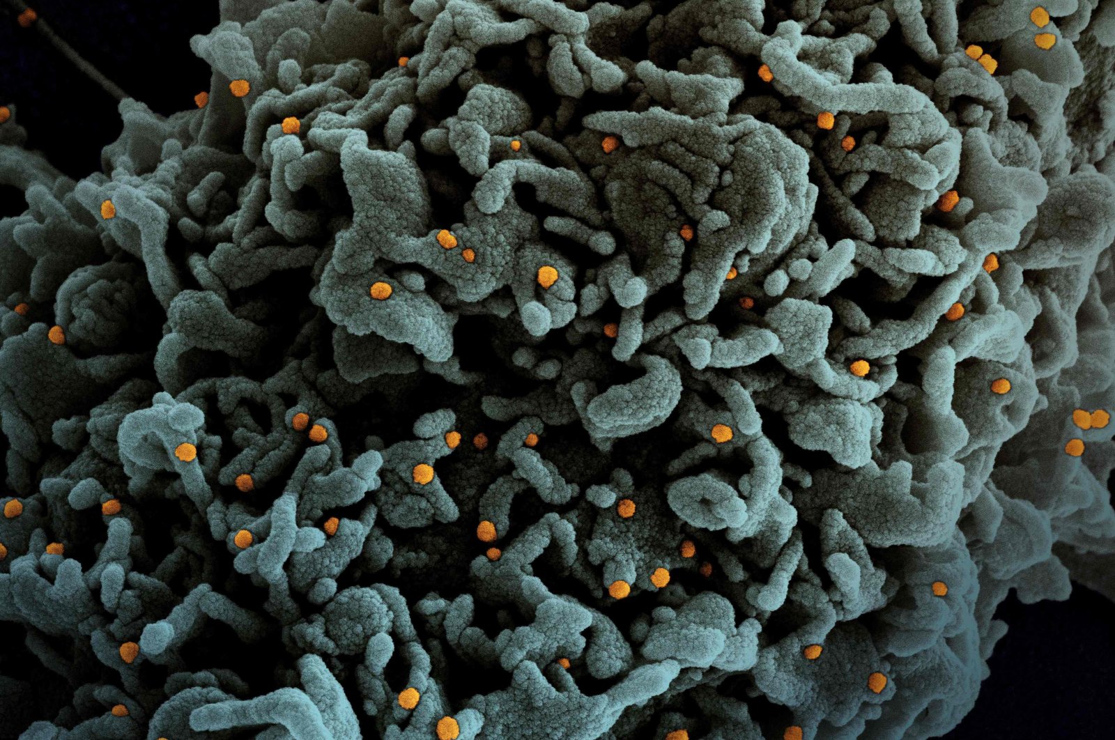 A colorized scanning electron micrograph of a cell (teal) infected with B.1.1.7 variant of COVID-19 virus particles (orange), isolated from a patient sample, March 31, 2021. (NIAID via AFP)