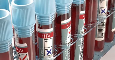 A U.S. patient with leukemia has become the first woman to be cured of HIV. (Shutterstock Photo)