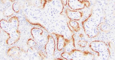 A microscope image shows placental cells from a stillbirth with SARS-CoV-2 infection indicated by the darker stains. (AP Photo)