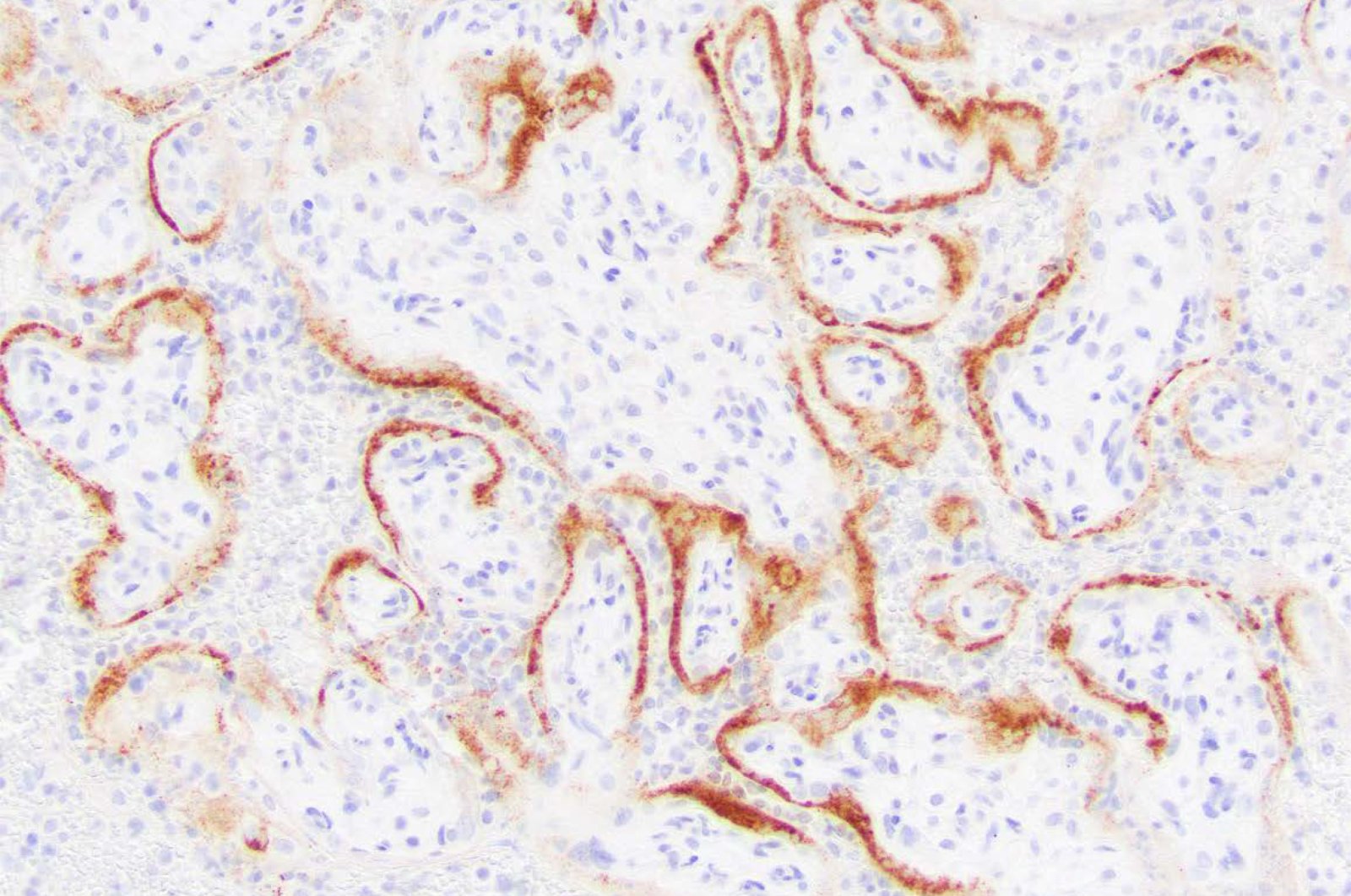A microscope image shows placental cells from a stillbirth with SARS-CoV-2 infection indicated by the darker stains. (AP Photo)