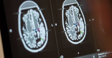 A cameraman films a human brain&#039;s profile on a computer screen during a press conference in Munich, Germany, Feb. 1, 2018. (Reuters Photo)