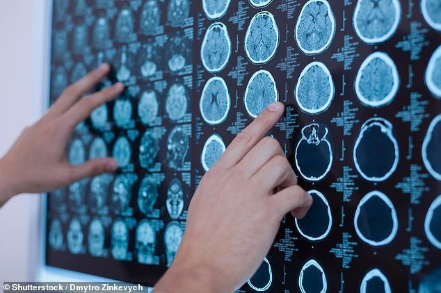 Computed tomography otak manusia.  (Shutterstock)