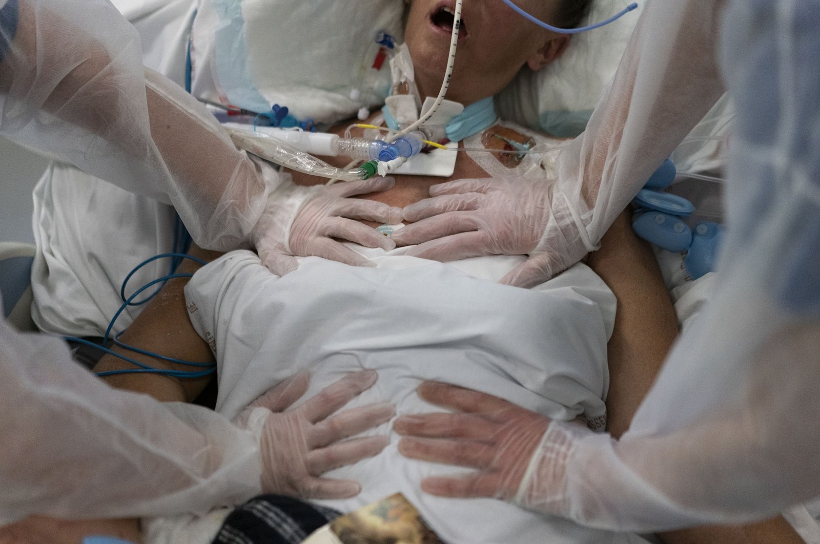 Nurses perform timed breathing exercises on a COVID-19 patient on a ventilator in the COVID-19 intensive care unit at the la Timone hospital in Marseille, southern France, Dec. 31, 2021. (AP Photo)
