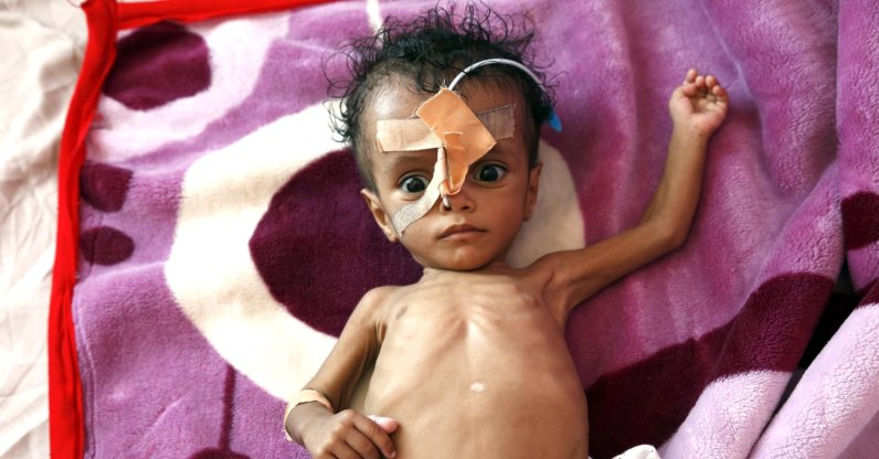 A baby receives treatment for malnutrition, Yemen, March 14, 2022. (AA Photo)