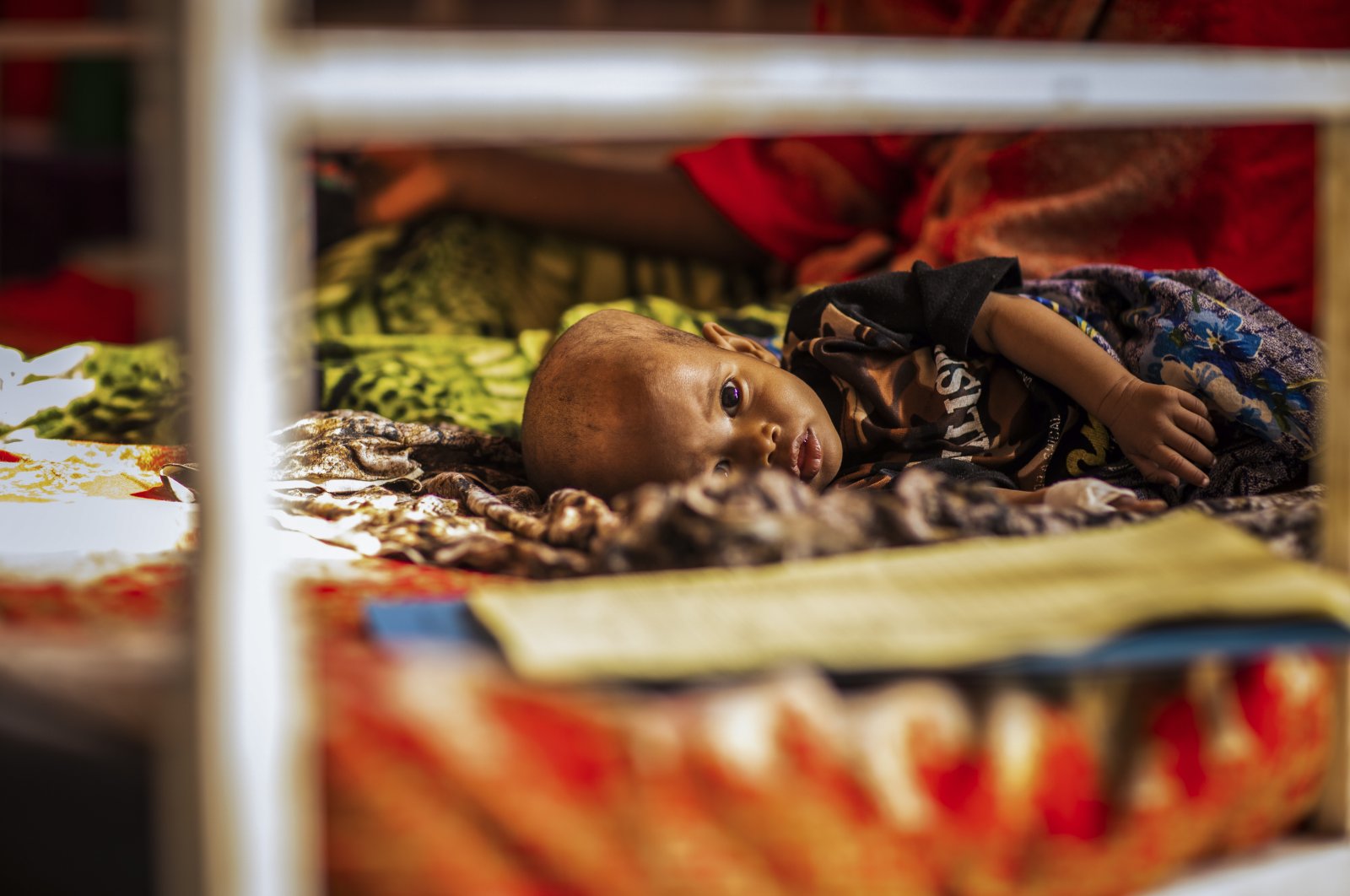 A severely malnourished baby receives treatment at a UNICEF-supported stabilization center at Gode Hospital in the Shabelle Zone of the Somali region of Ethiopia, April 12, 2022. (AP Photo)