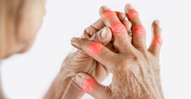 A woman massages her finger to relieve joint pain caused by gout, April 25, 2022. (Shutterstock Photo)