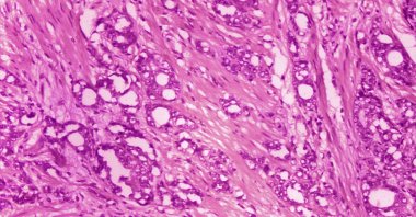A microscope image shows changes in cells indicative of adenocarcinoma of the prostate, 1974. (CDC via AP)