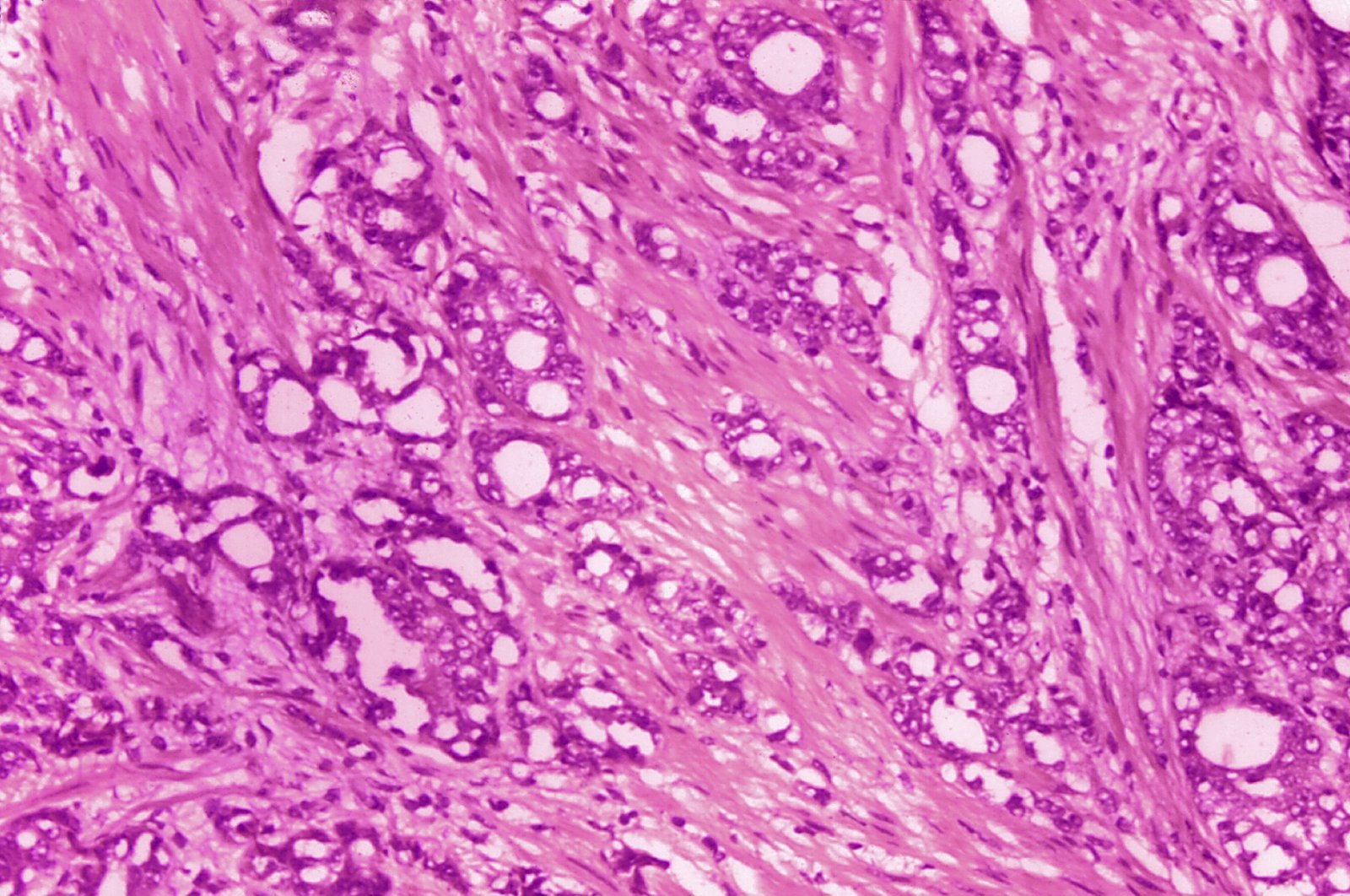 A microscope image shows changes in cells indicative of adenocarcinoma of the prostate, 1974. (CDC via AP)