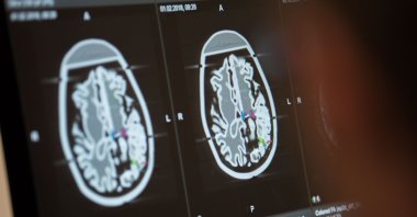 What happens to us in the moments when we die? Until now, knowledge about this has mainly come from near-death experiences. Now an accidental discovery offers new insights, Feb. 1, 2018. (DPA Photo)