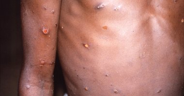 An image created during an investigation into an outbreak of monkeypox, which took place in the Democratic Republic of the Congo, 1996 to 1997, shows the arms and torso of a patient with skin lesions due to monkeypox, in this undated image obtained by Reuters, May 18, 2022. (CDC via Ruters)
