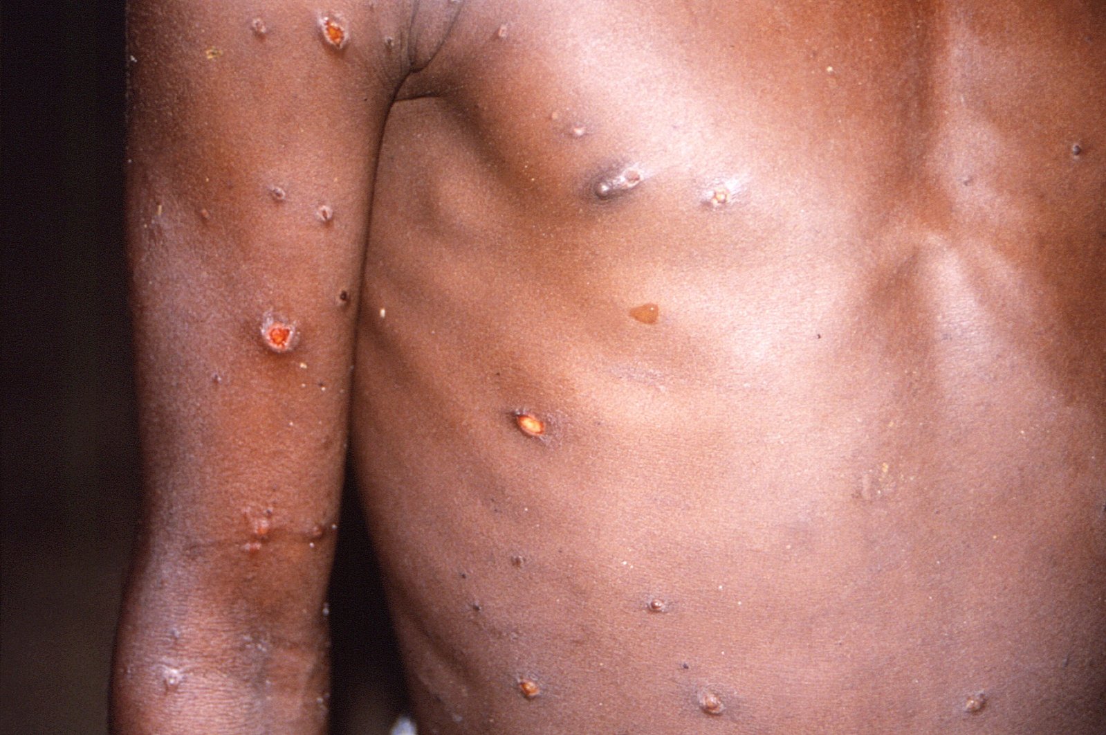 An image created during an investigation into an outbreak of monkeypox, which took place in the Democratic Republic of the Congo, 1996 to 1997, shows the arms and torso of a patient with skin lesions due to monkeypox, in this undated image obtained by Reuters, May 18, 2022. (CDC via Ruters)