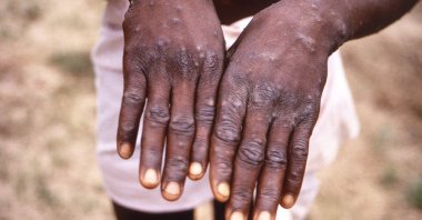 The hands of a patient with a rash due to monkeypox are seen during an investigation into an outbreak, which took place in the Democratic Republic of the Congo, 1996 to 1997, in this undated image obtained by Reuters on May 18, 2022. (Reuters Photo)