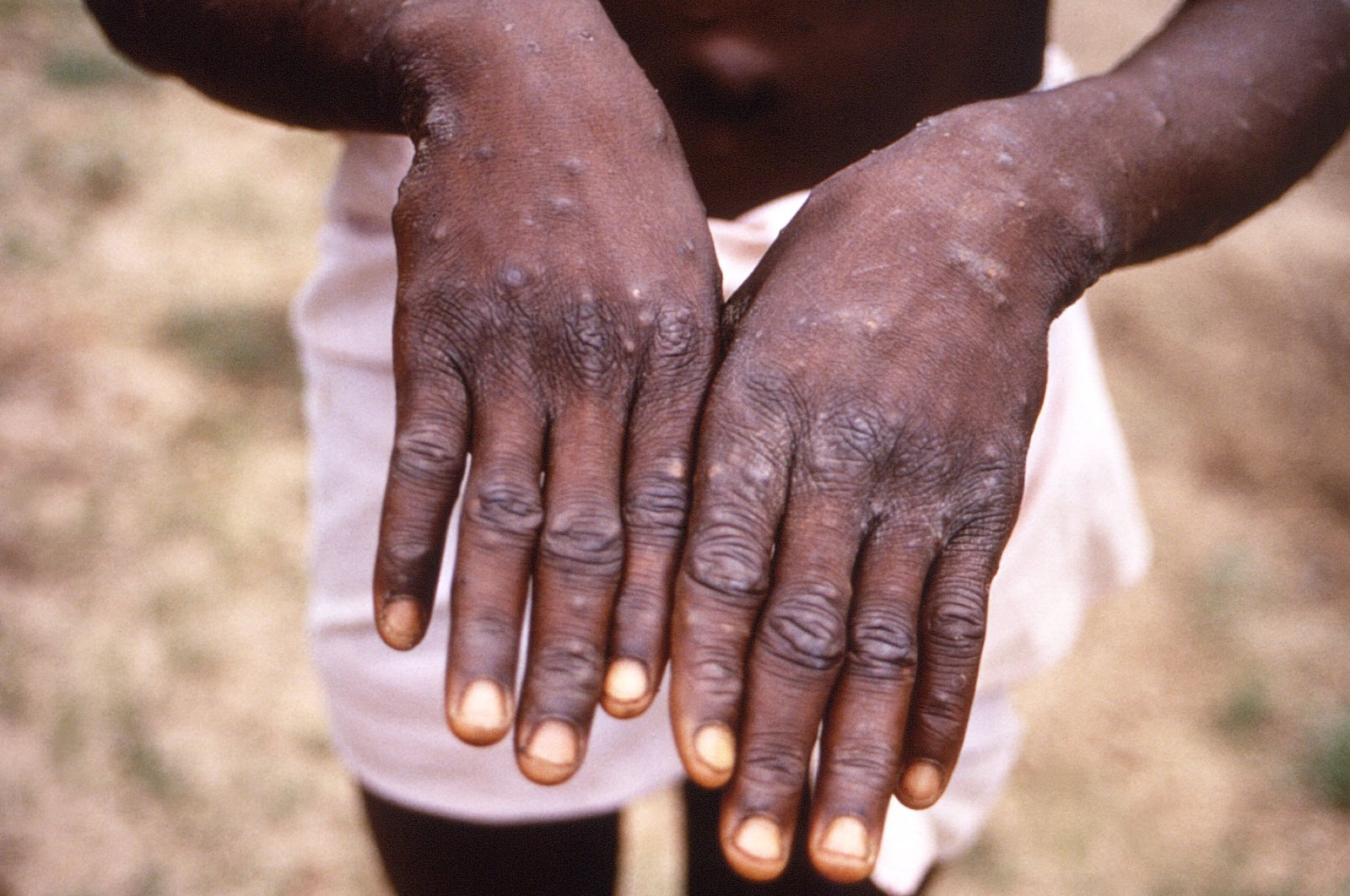 The hands of a patient with a rash due to monkeypox are seen during an investigation into an outbreak, which took place in the Democratic Republic of the Congo, 1996 to 1997, in this undated image obtained by Reuters on May 18, 2022. (Reuters Photo)