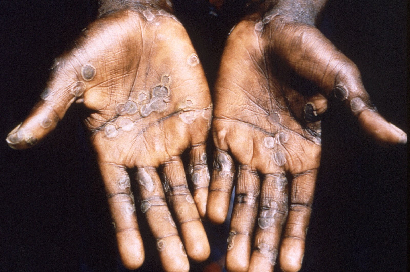 The palms of a monkeypox patient from Lodja, a city located within the Katako-Kombe Health Zone, are seen during a health investigation in the Democratic Republic of Congo in 1997. (Brian W.J. Mahy/CDC/Handout via REUTERS)