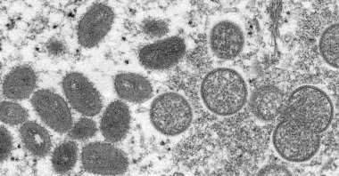 An electron microscope image shows mature, oval-shaped monkeypox virions (L), and spherical immature virions (R), obtained from a sample of human skin associated with the 2003 prairie dog outbreak. (CDC via AP)