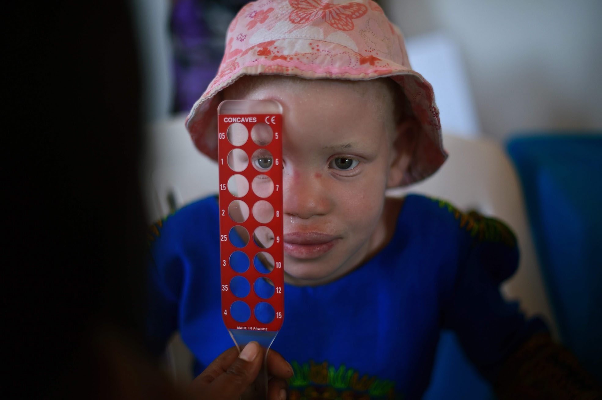 Seorang gadis dengan albinisme menjalani tes matanya di sebuah klinik yang dijalankan oleh LSM Standing Voice, di Pulau Ukerewe di Danau Victoria selama hari Kesadaran Albinisme Internasional, Tanzania, 13 Juni 2016. (AFP Photo)