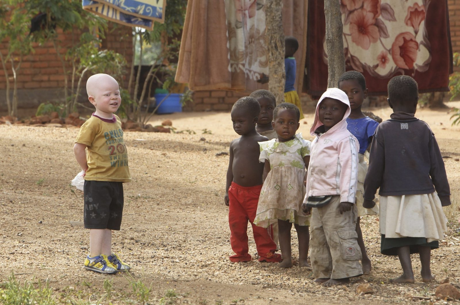 Cassim Jaffalie, 3, who has albinism, stands with his friends at their family home, in Machinga about 200 kilometers (125 miles) northeast of Blantyre, Malawi, May 23, 2016. (AP Photo)