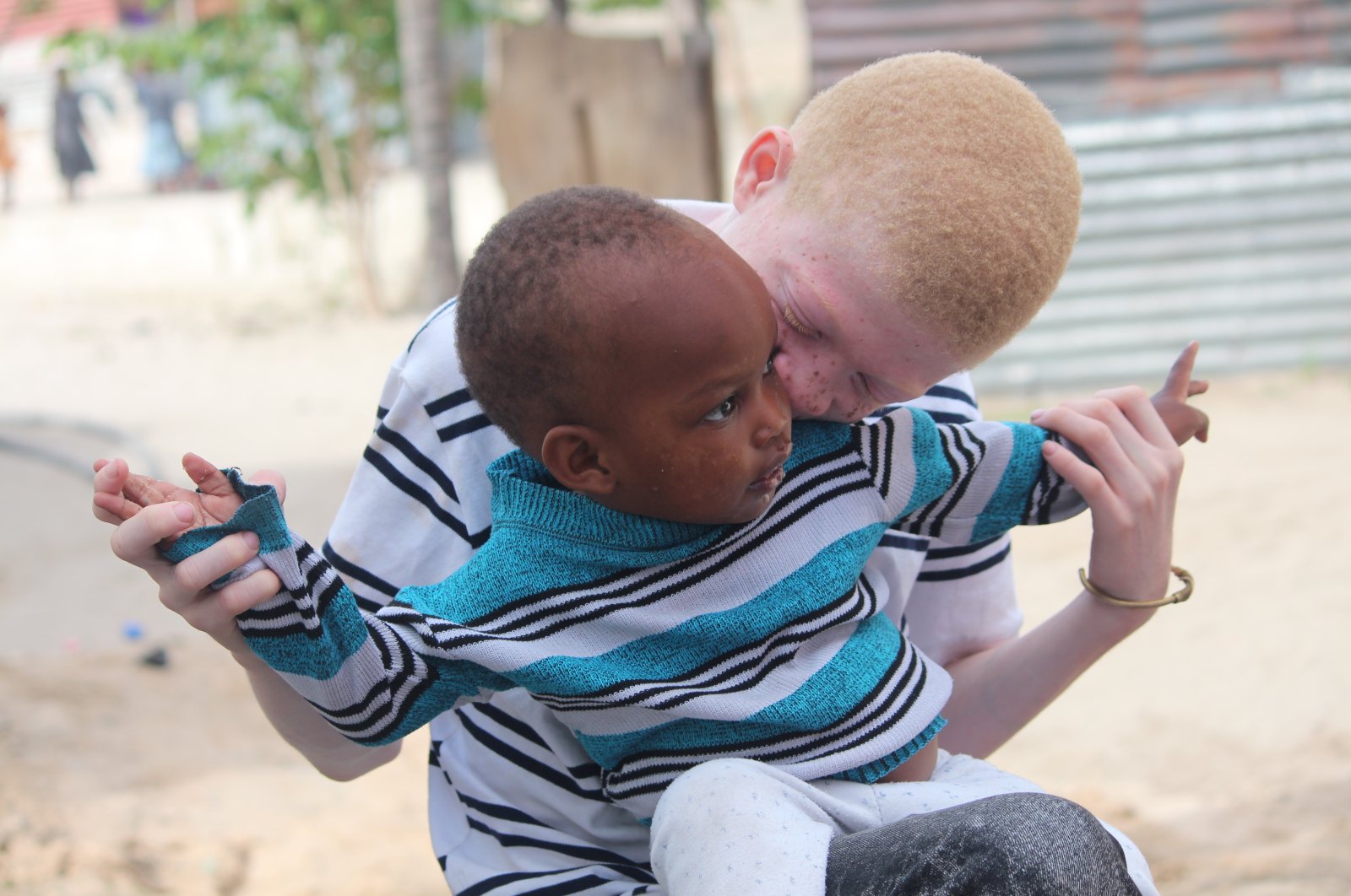 Individu dengan albinisme menghadapi pelanggaran hak asasi manusia secara global