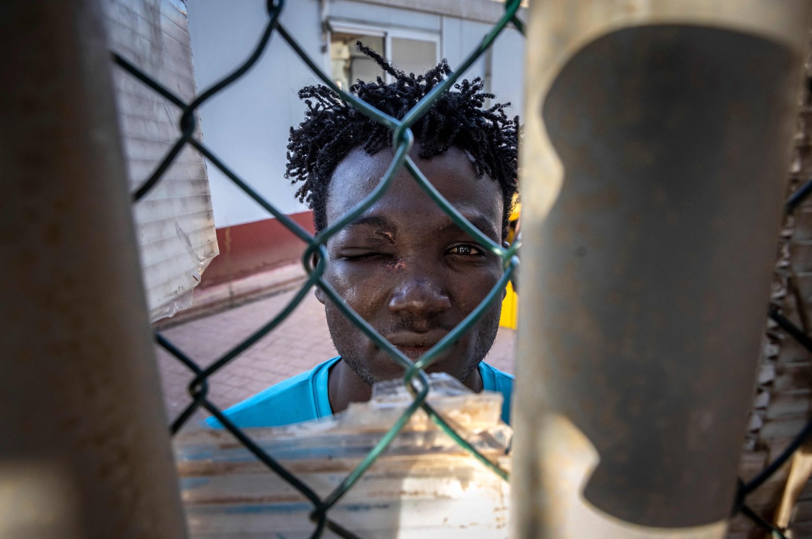 A Sudanese migrant with an eye injury is pictured in the temporary center for immigrants and asylum-seekers in the Spanish enclave of Melilla, Spain, June 25, 2022. (AFP Photo)
