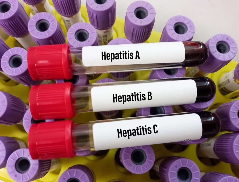 Hepatitis claim more than 1 million lives every year while most cases go undiagnosed due to late appearing symptoms. (Shutterstock Photo) 