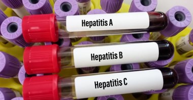 Hepatitis claim more than 1 million lives every year while most cases go undiagnosed due to late appearing symptoms. (Shutterstock Photo) 