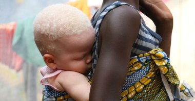 An albino baby sleeps in a sling on her sister's back in this undated picture, Sierra Leone, Africa. (Alamy via Reuters)