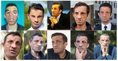 Türkiye&#039;s first face transplant patient Uğur Acar before and after his surgery. (AA Photo)