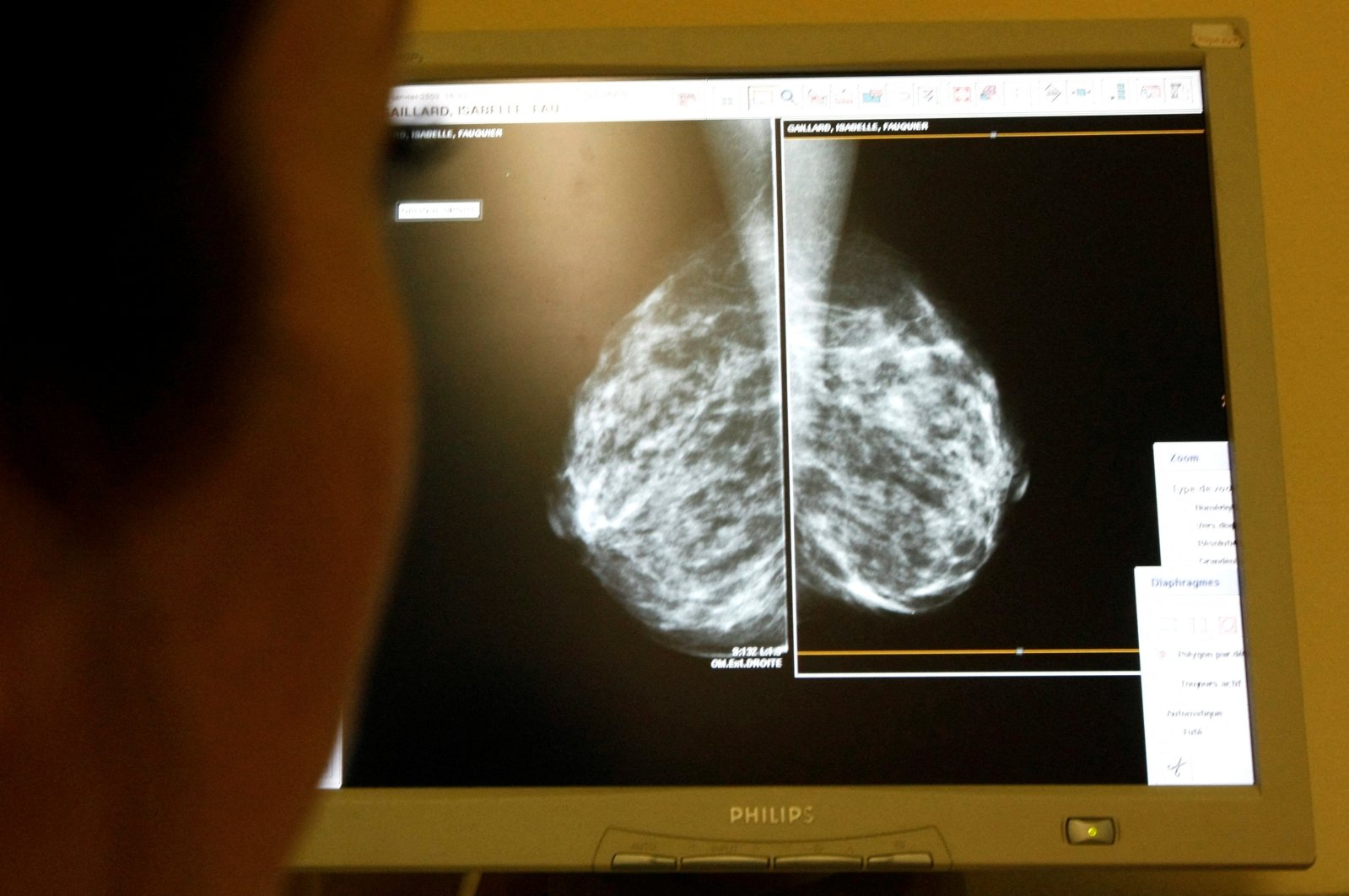 A doctor exams mammograms, a special type of X-ray of the breasts used to detect tumors, at a clinic in Nice, France, Jan. 4, 2008. (Reuters Photo)