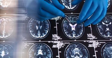 A doctor reviews magnetic resonance imaging scans of the brain. (Getty Images Photo)