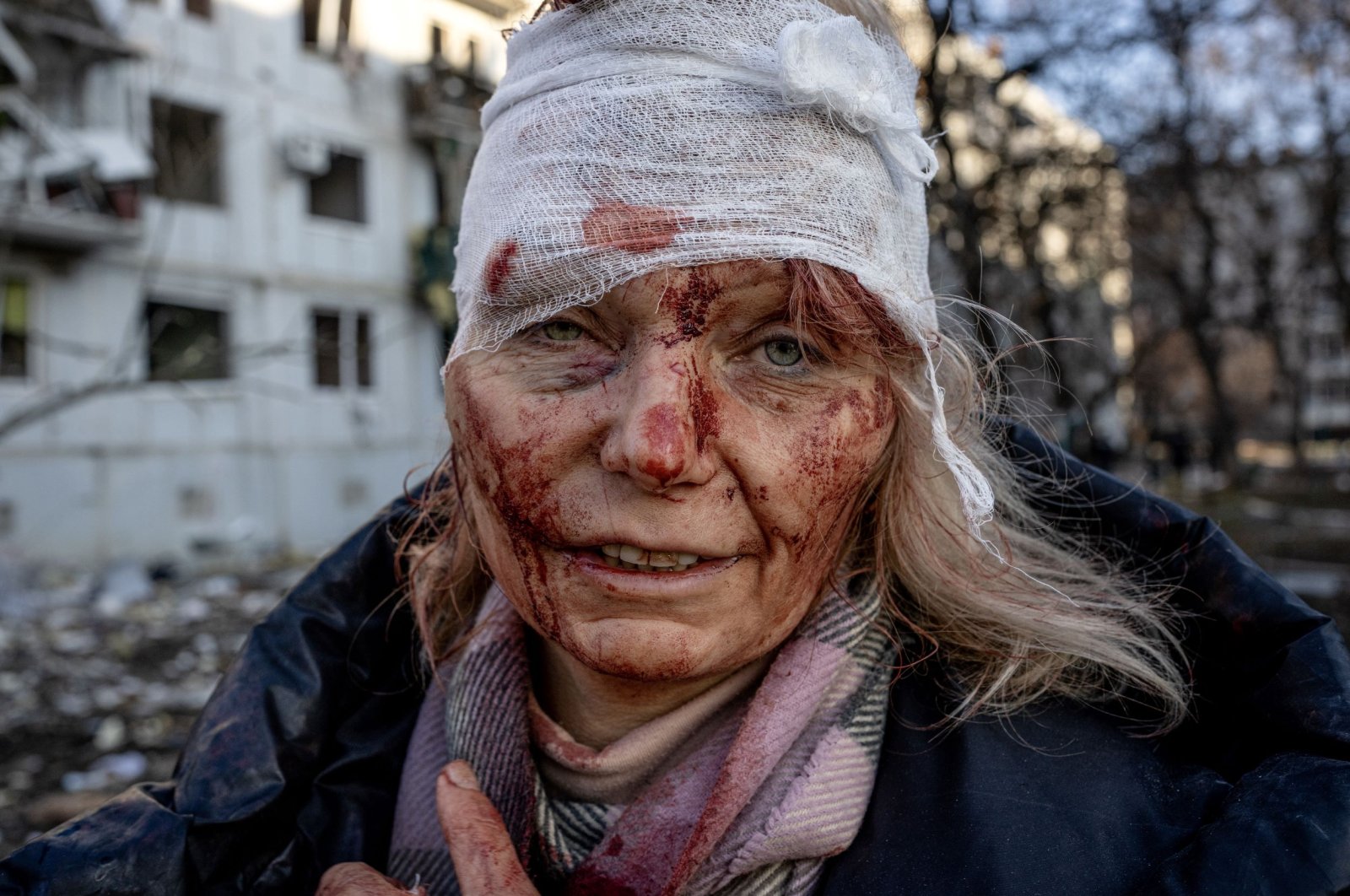 53-year-old teacher Olena Kurilo injured in Russian shelling of an apartment complex in Chuhuiv, Ukraine, Feb. 24, 2022. (AA Photo)