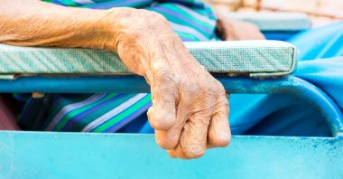 Leprosy doesn't spread easily yet, it is still a major issue around the world. (Shutterstock Photo)