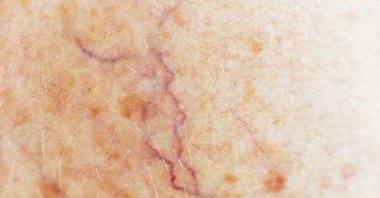 Small, widened blood vessels on the skin are usually harmless but can be associated with several diseases and require surgical intervention. (Getty Images Photo)