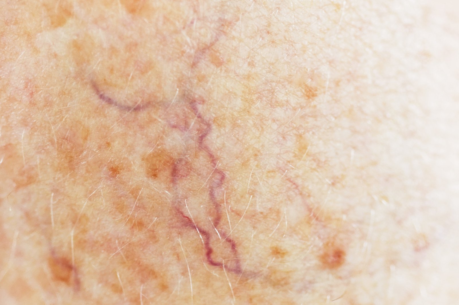 Small, widened blood vessels on the skin are usually harmless but can be associated with several diseases and require surgical intervention. (Getty Images Photo)