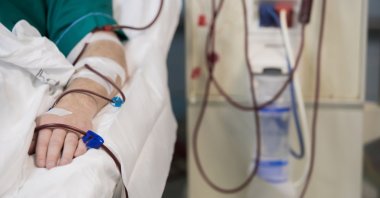 Patient's hand is seen during hemodialysis treatment. (Shutterstock Photo)
