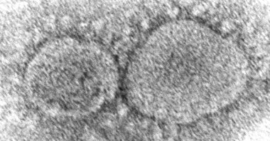 An electron microscope image shows SARS-CoV-2 virus particles. (AP Photo)