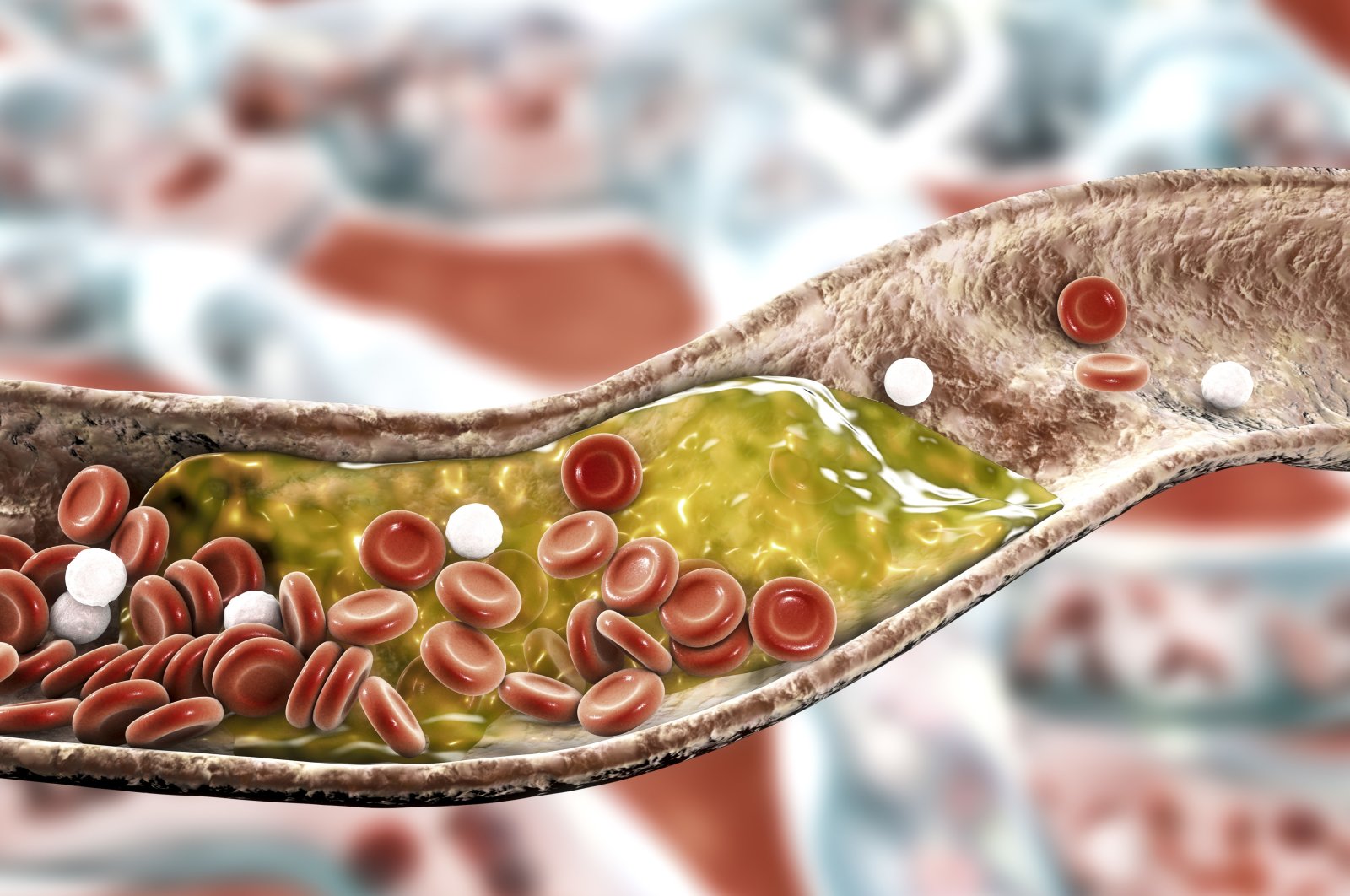 A computer illustration shows atheromatous plaque inside an artery. (Getty Images Photo)