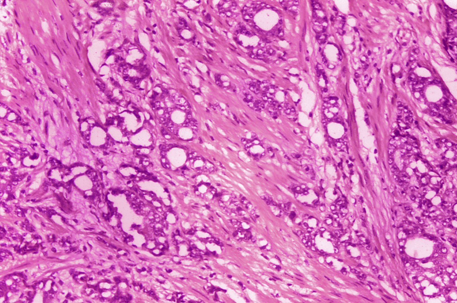 A microscope image shows changes in cells indicative of adenocarcinoma of the prostate. (AP Photo)