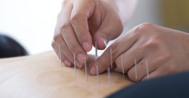 The ancient method of acupuncture can help people quit smoking, according to doctors. (Getty Images Photo)