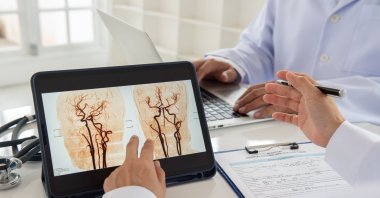 A brain aneurysm is caused by thinning artery walls or stenosis (narrowing) in the brain vessels. (Shutterstock File Photo)