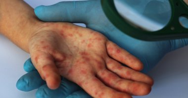 A patient is seen with red rashes caused by the viral disease measles, June 19, 2023. (Shutterstock Photo)