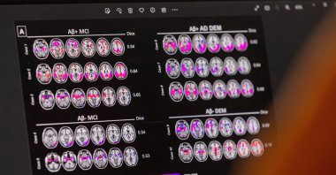  A scientist looks at hypometabolic and hypoperfusion patterns at the single-subject level from a patient suffering from Alzheimer&#039;s disease at the Memory Centre at the Department of Readaptation and Geriatrics of the University Hospital (HUG), in Geneva, Switzerland, June 6, 2023. (Reuters File Photo)