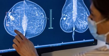 Doctors and scientists from Sweden's Lund University have found that AI-supported mammography screening "almost halved radiologist workload" during a randomized trial under a Swedish national breast cancer screening program. (dpa Photo)