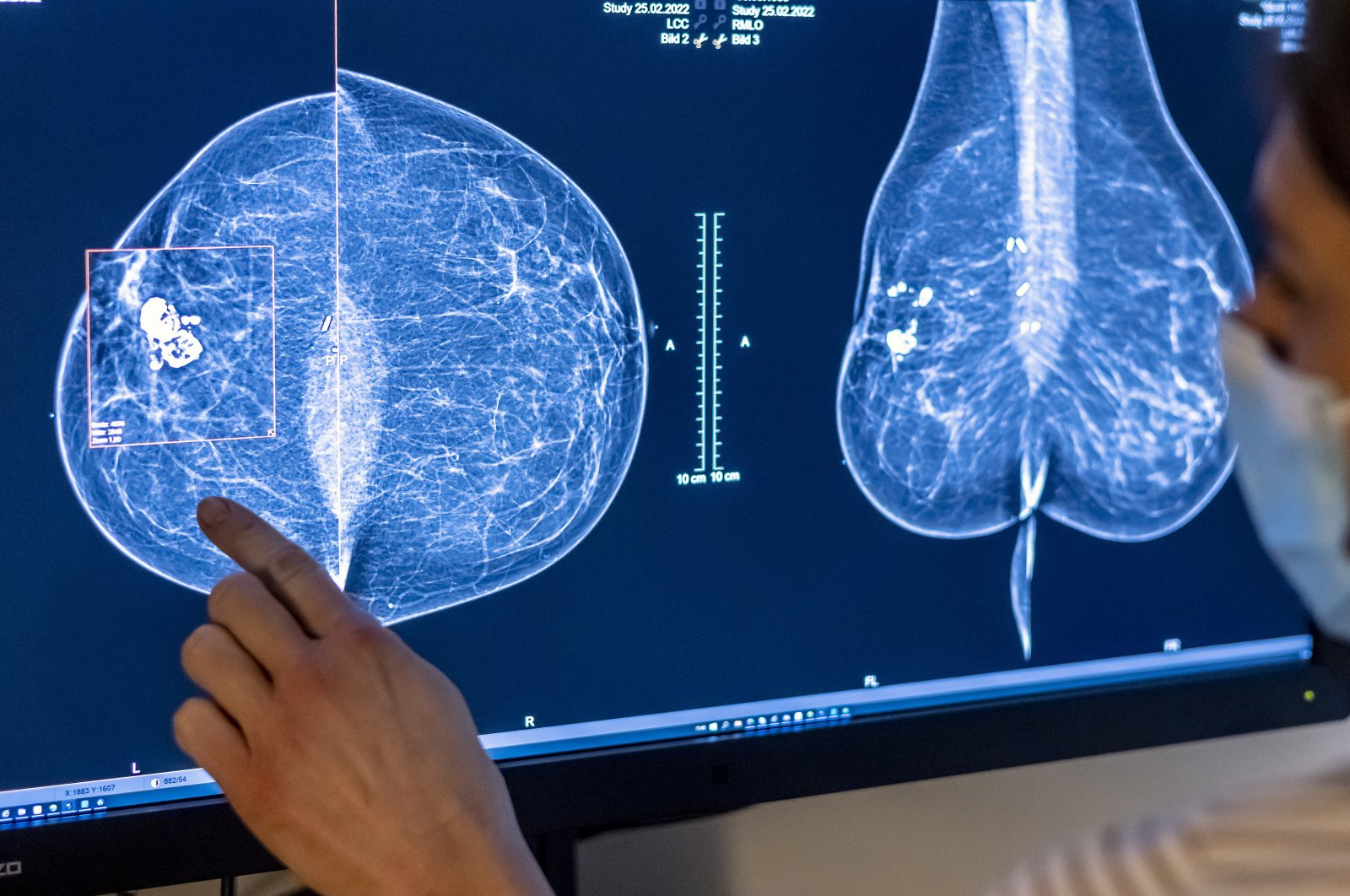 Doctors and scientists from Sweden&#039;s Lund University have found that AI-supported mammography screening &quot;almost halved radiologist workload&quot; during a randomized trial under a Swedish national breast cancer screening program. (dpa Photo)