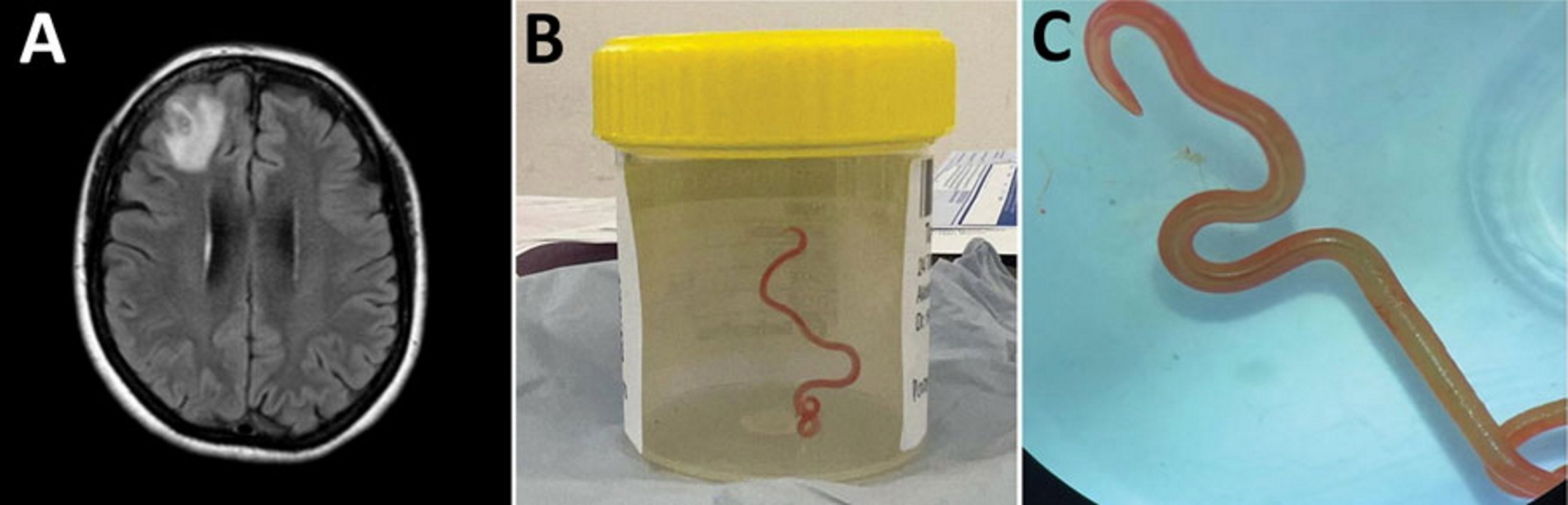 An undated handout photo made available by Australian National University issued a composite picture after a Ophidascaris robertsi roundworm was found alive in the brain of an Australian woman in 2022, Canberra, Australia, Aug. 29, 2023. (EPA Photo)