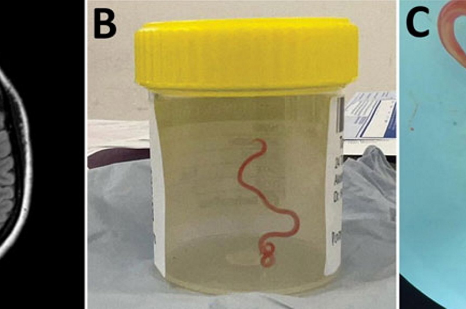 Neurosurgeon extracts 3-inch parasitic worm from patient’s brain in Australia